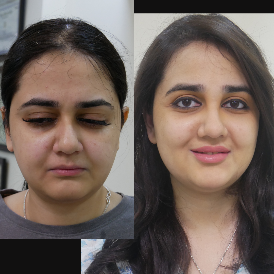 Hydra Facial in Bhopal Near You Nikky Bawa Medi Salon