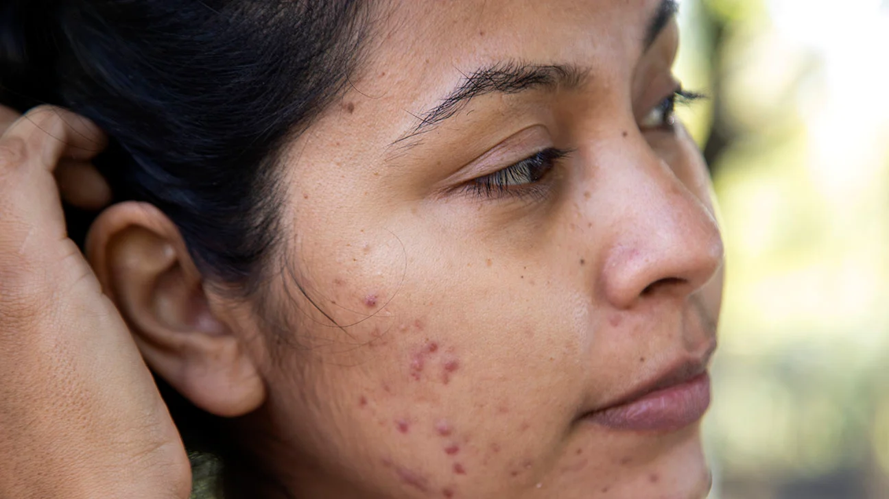 Which Treatment Is Right for Acne Scars?