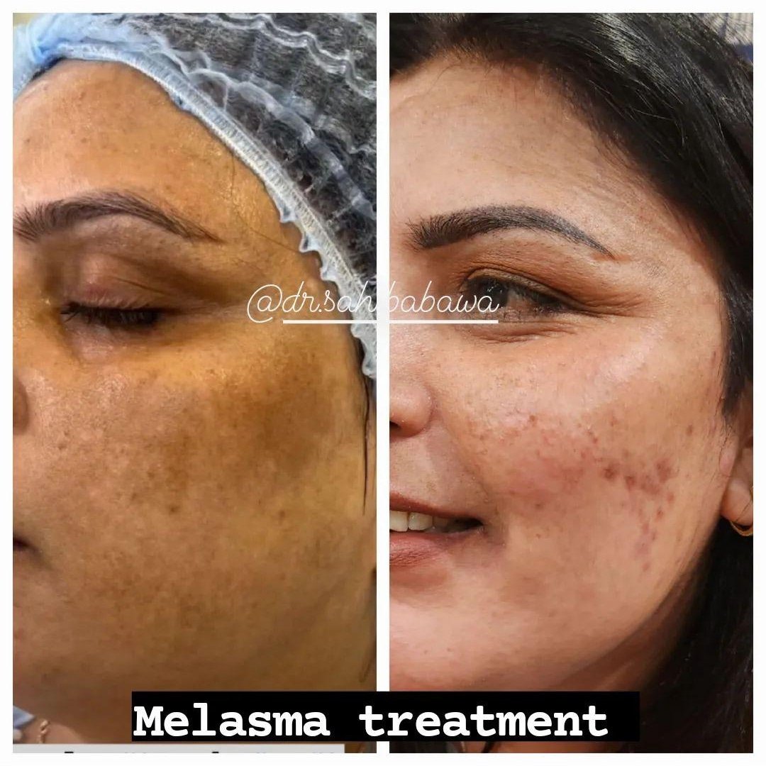 What to Expect from Your First Melasma Laser Treatment?