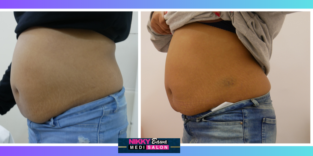 Best belly skin tightening treatments in Bhopal