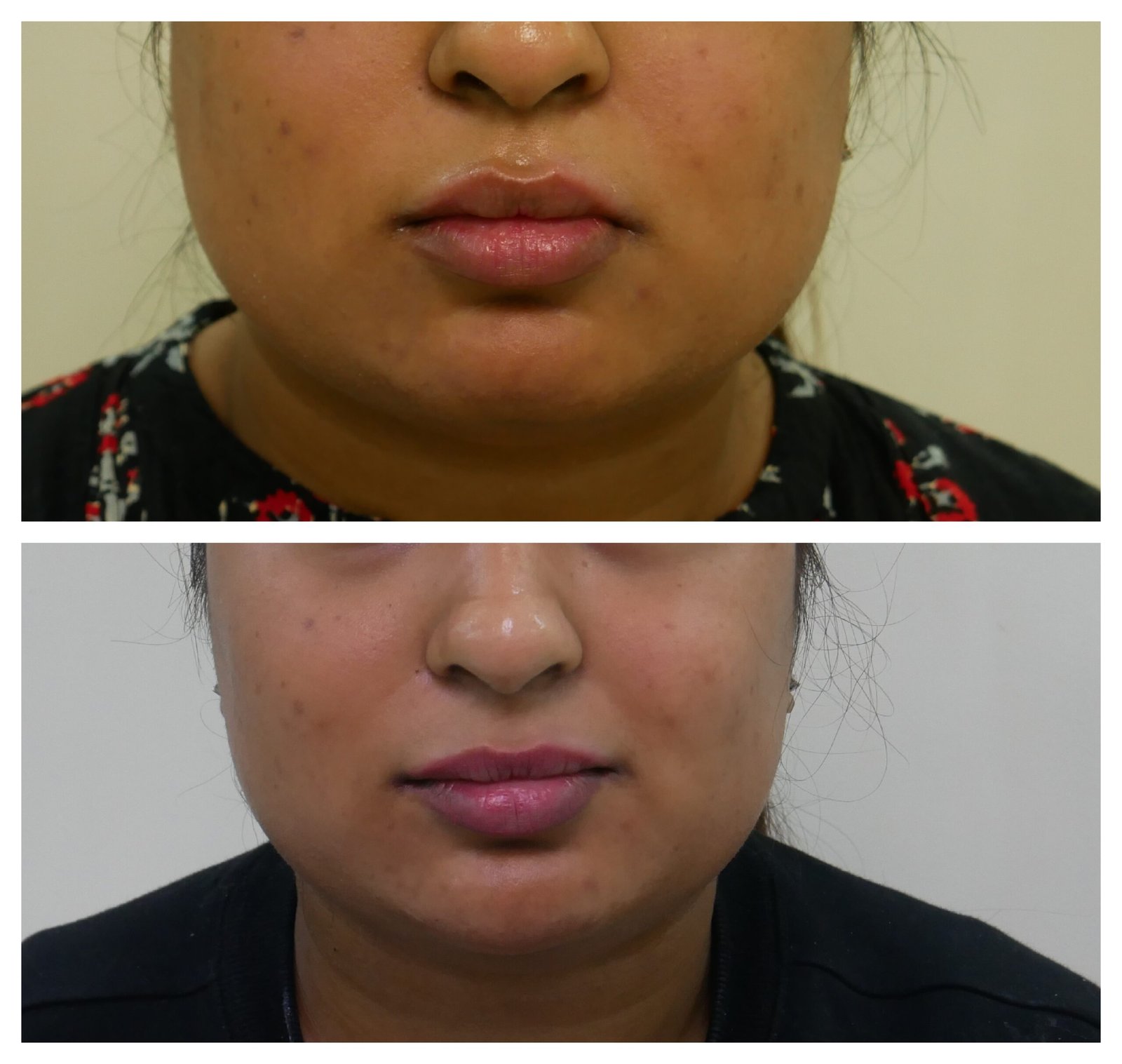 Achieving Your Dream Face Shape with Face Slimming Treatments