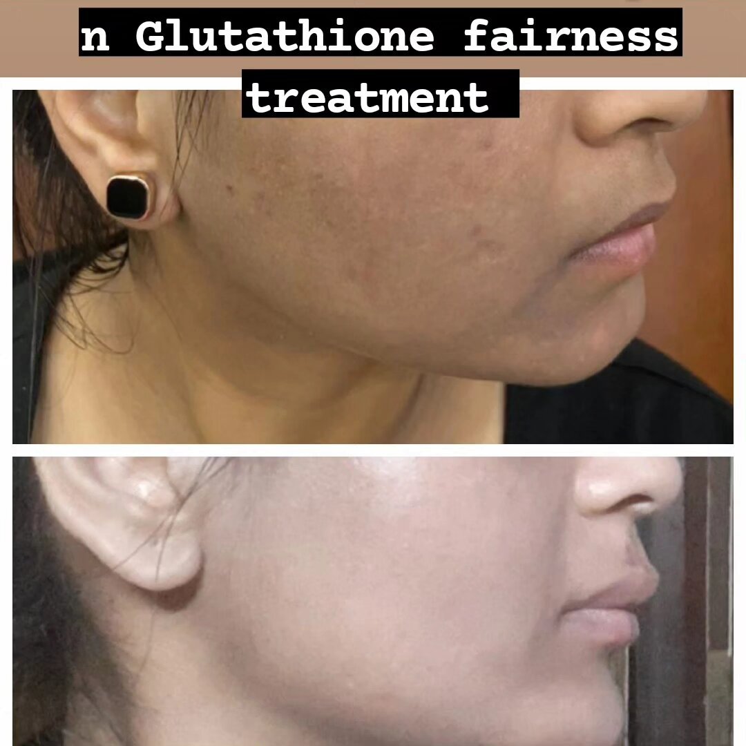 Is Glutathione Skin Whitening Treatment Right for You?