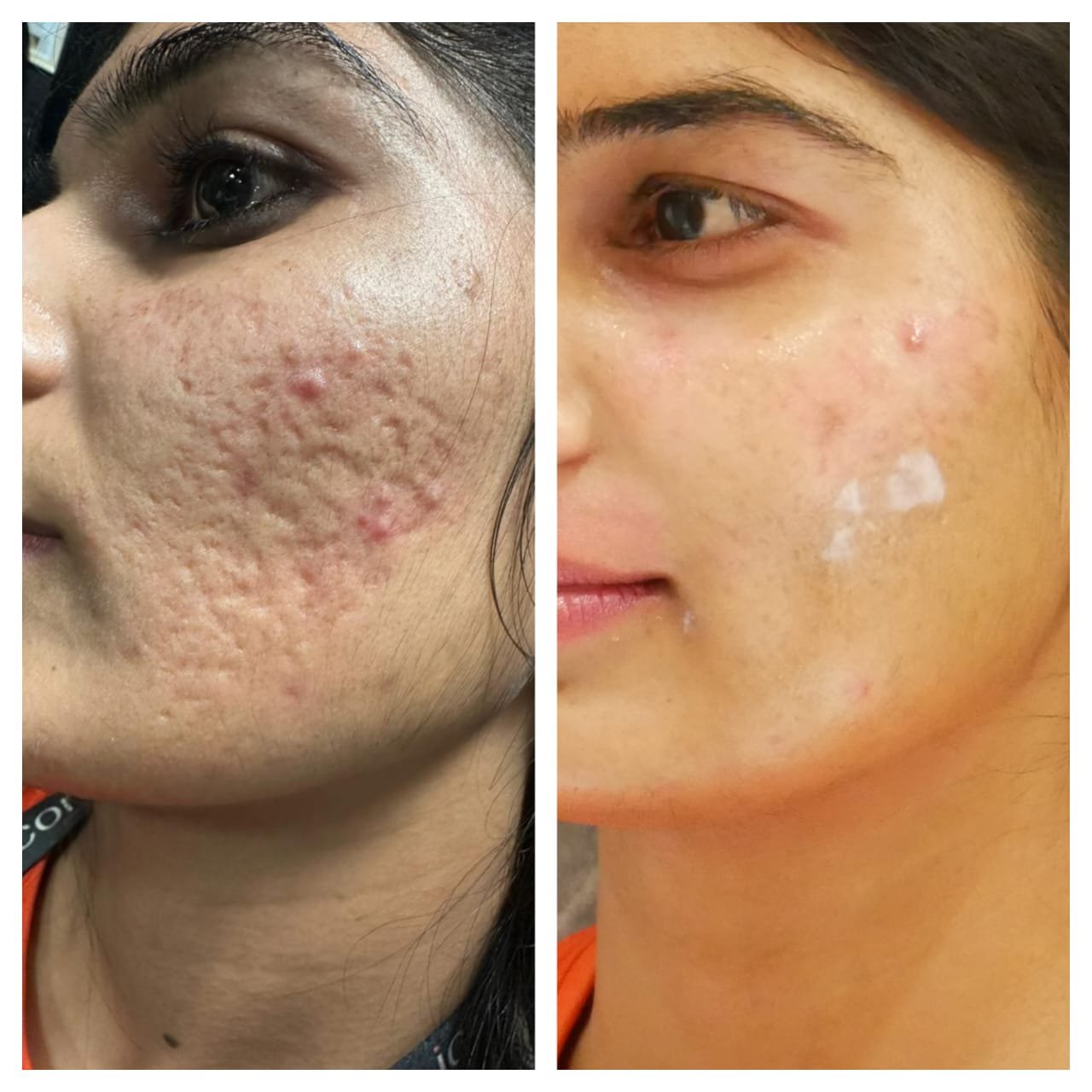 Can A Medi Facial Help with Pigmentation?  Here’s What You Need to Know!