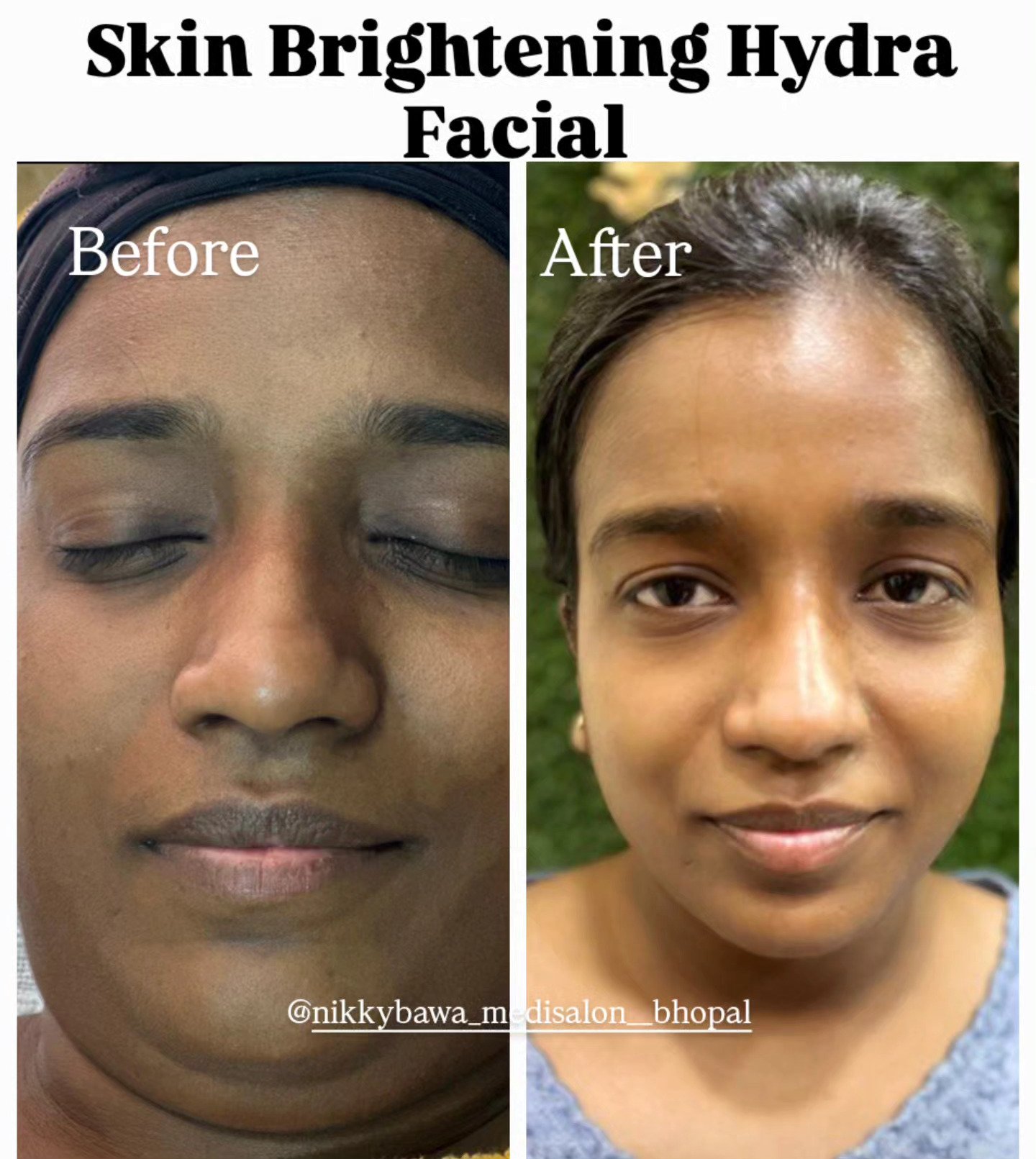 Home Remedies vs Professional Skin Whitening – Why Choose a Medi Salon?