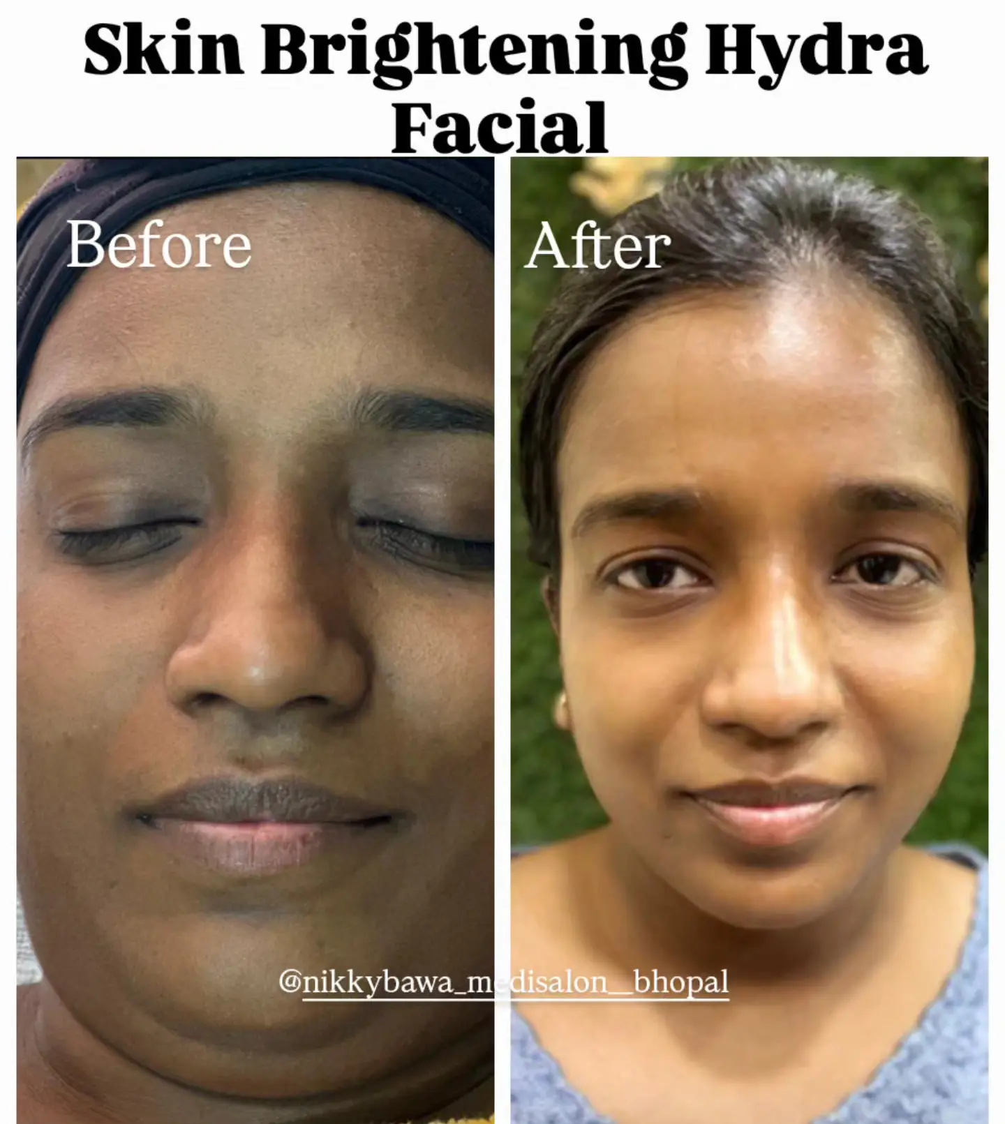 Home Remedies vs Professional Skin Whitening – Why Choose a Medi Salon?