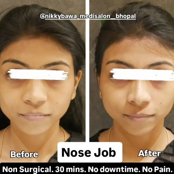 nose-job-before-after-img-1