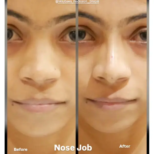 nose-job-before-after-img