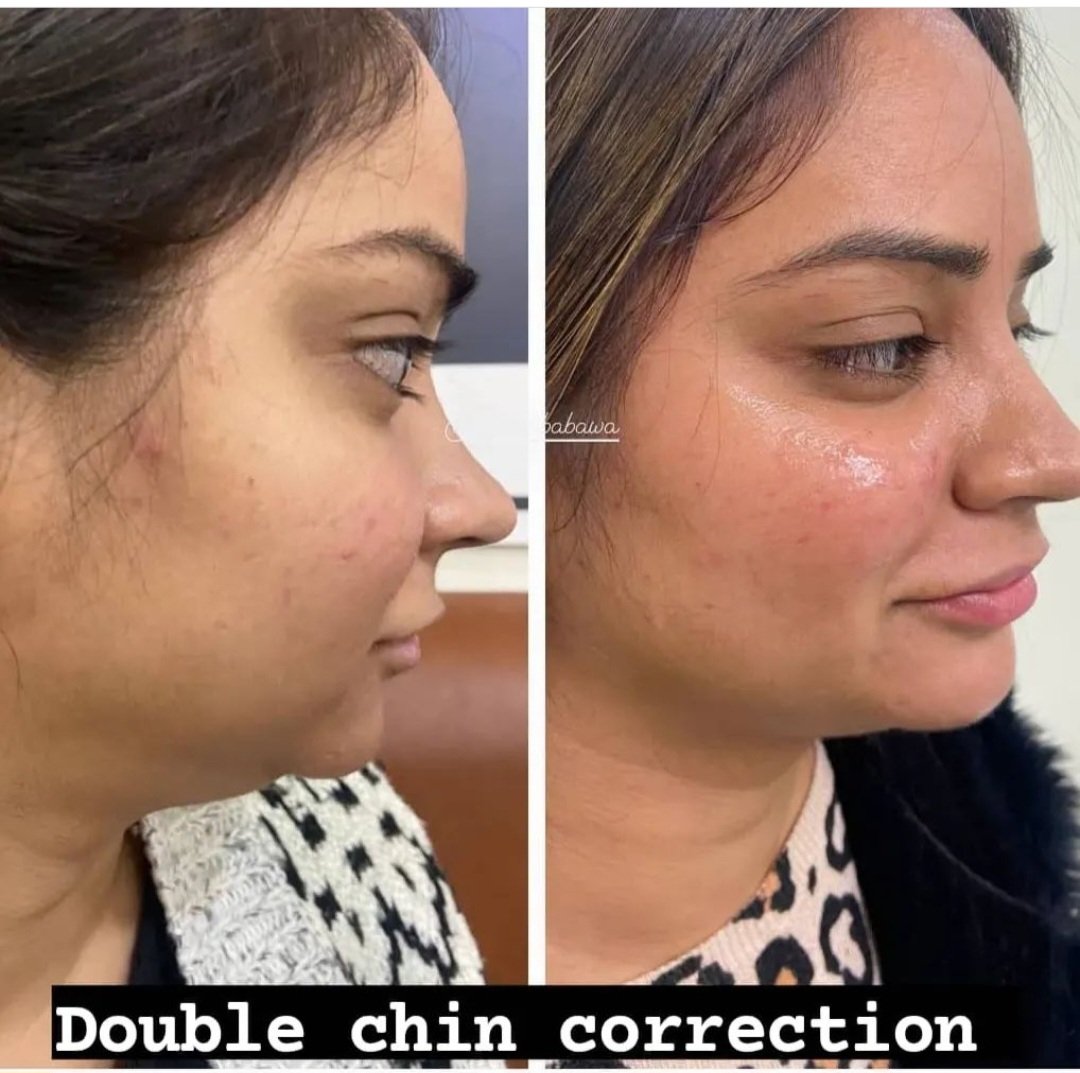 Cheek and Chin Filler Trends: How Fillers Can Change Your Look?