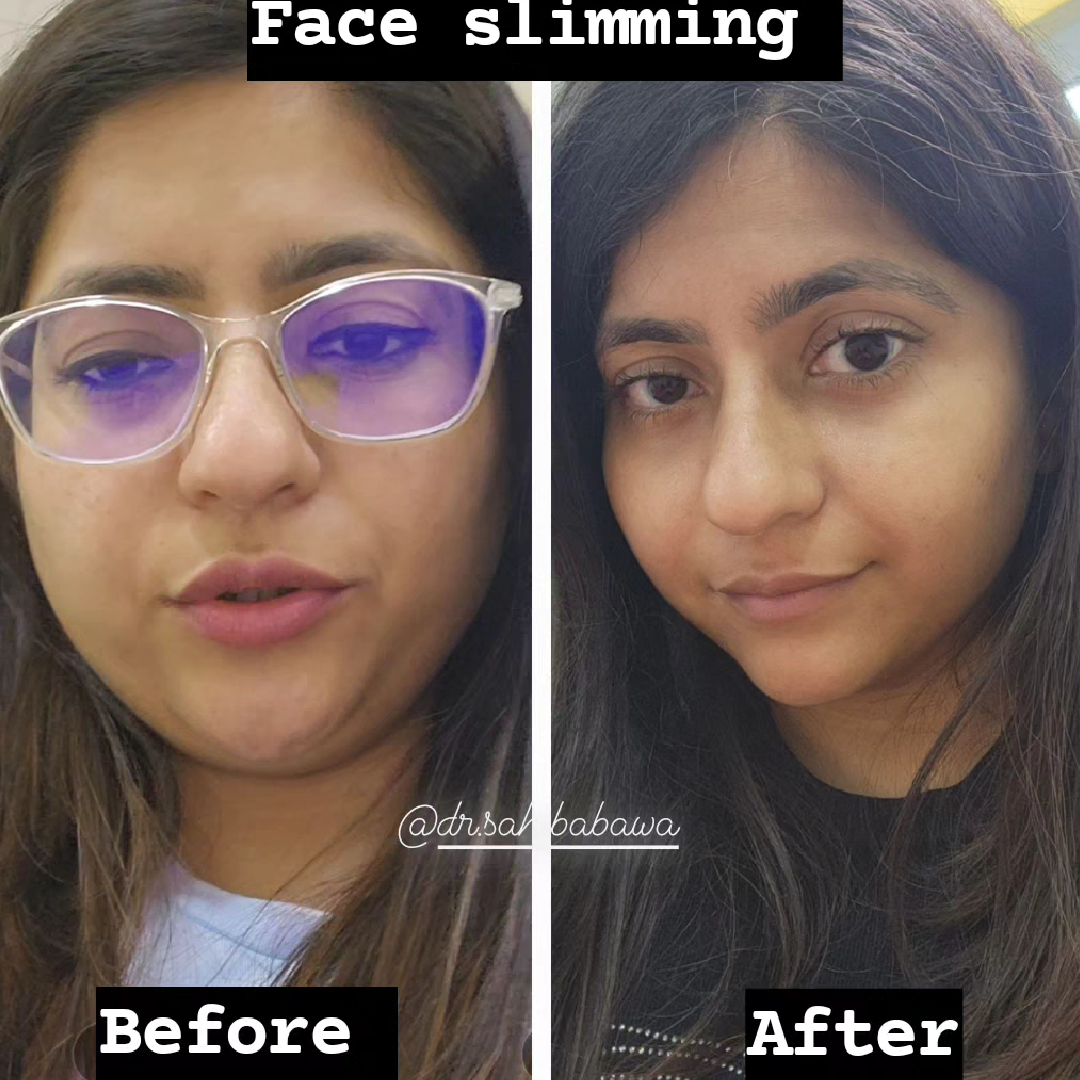 How Face Slimming Treatment Works?
