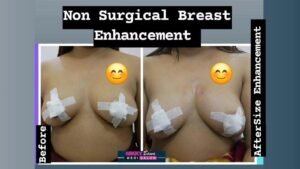 breast tightening treatment Bhopal 2025, RF laser mesotherapy breast firming, sagging breast solutions Bhopal clinic, non-surgical breast lift Madhya Pradesh