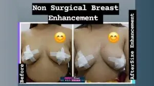 breast tightening treatment Bhopal 2025, RF laser mesotherapy breast firming, sagging breast solutions Bhopal clinic, non-surgical breast lift Madhya Pradesh