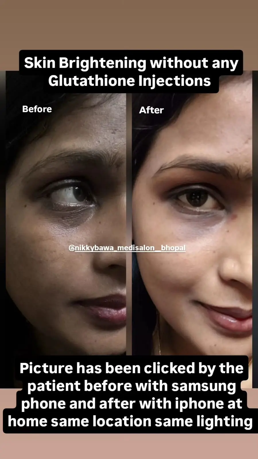 glutathione injection for skin brightening 💉 Glutathione IV Therapy for Skin Whitening main image 0