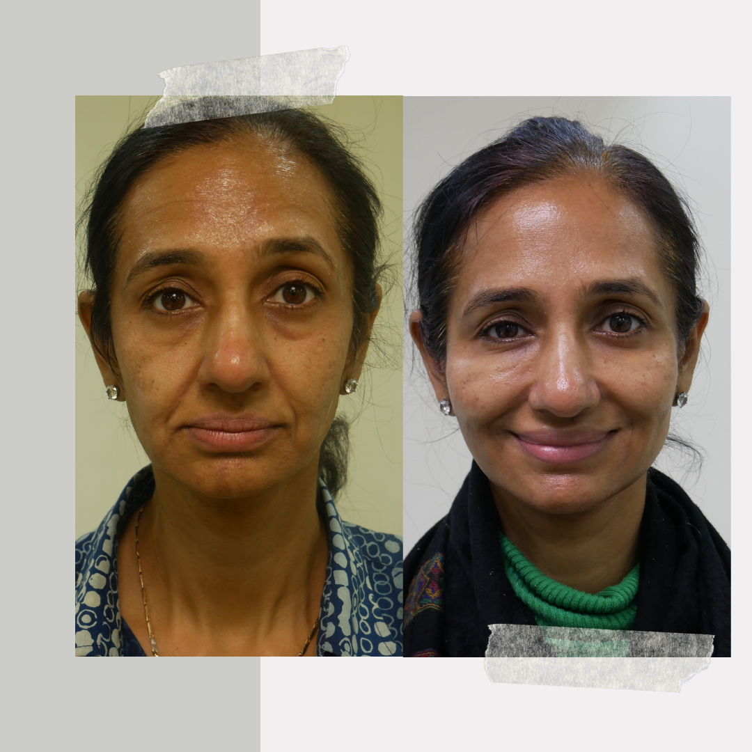 How Derma Fillers Help with Wrinkles?