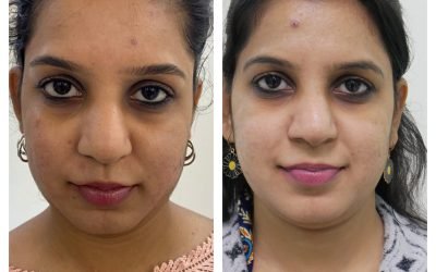 Trsuted Face Lift Treatment