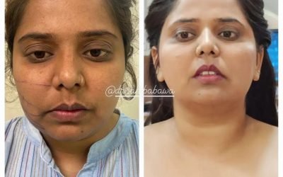 Face Slim Treatment Without Surgery